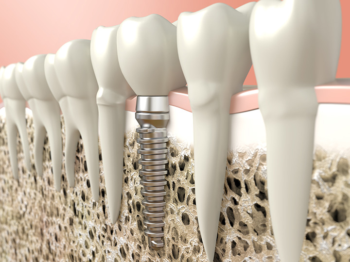 Dental Implants Toronto Dentist